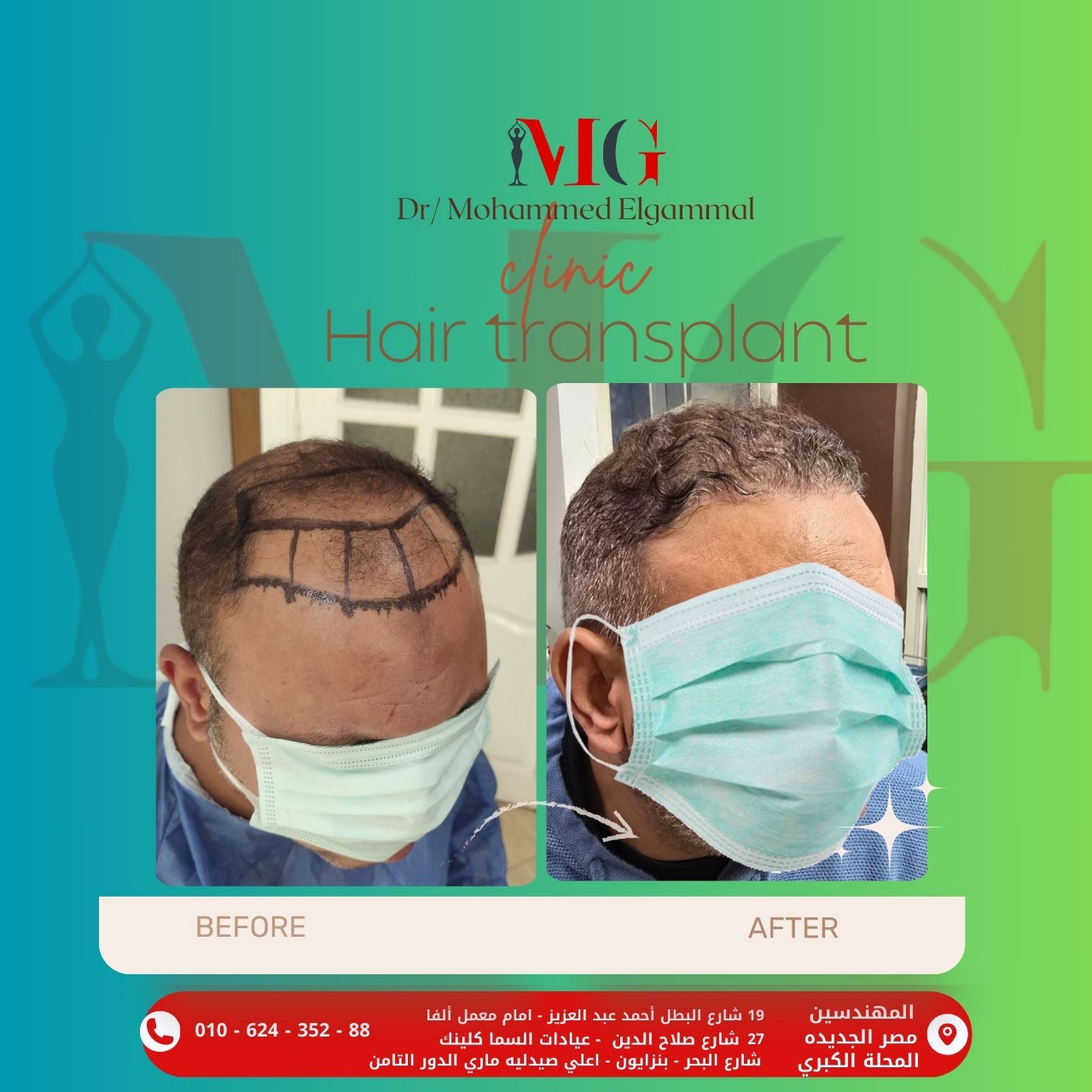 زراعة شعر ٣